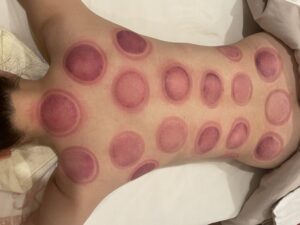 カッピング直後