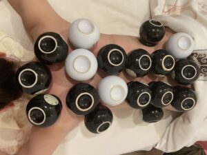 中国式カッピング